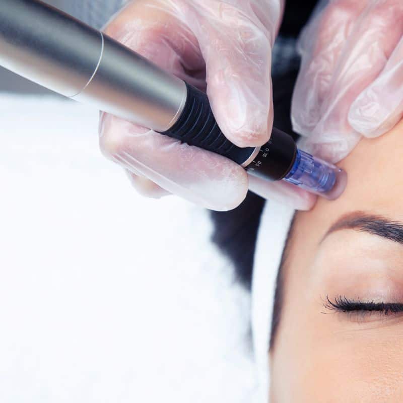 Morpheus8 treatment Perivale from Lipo Sculpt - Book in today!
